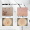 Picture of VT Reedle Shot 300 - Korean Microneedle Skincare Ampoule